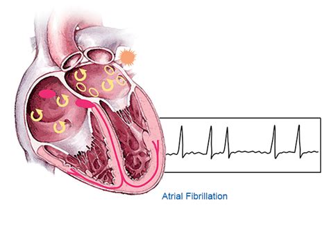 Atrial Fibrillation 的图像结果