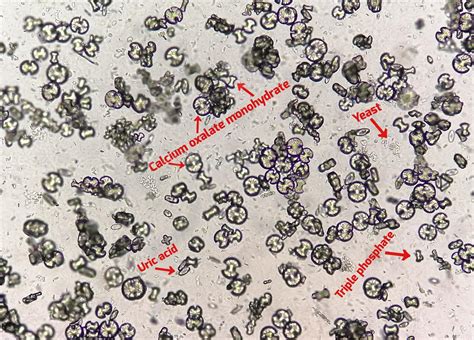 Calcium Phosphate Kidney Stones Formula at Sandra Wells blog