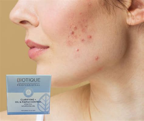 Biotique Professional Clarifying Oil & Pimple Control - Prokarehub