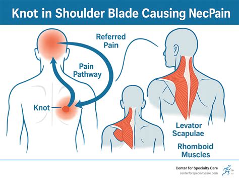 Knot in shoulder blade causing neck pain: Ultimate Relief 2025