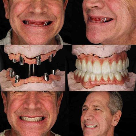 How much does a full mouth of dental implants cost - Dental News Network