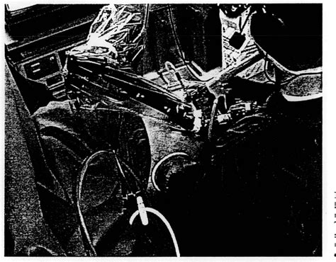 Image result for Hand-Assisted Nephrectomy