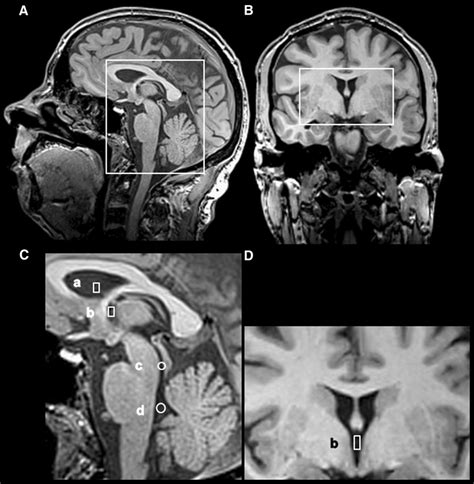 CSF Ventricular System 的图像结果