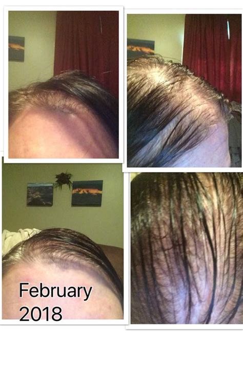 hair regrowth