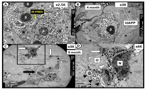 An Immediate and Long-Term Complication of COVID-19 May Be Type 2 ...