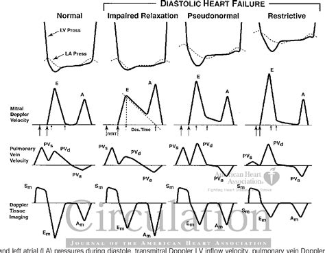 Image result for Moderate Diastolic Dysfunction
