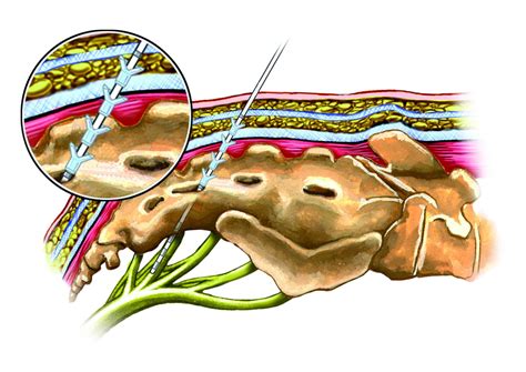 Sacral nerve stimulation / sacral neuromodulation | Privatklinik | Beta ...