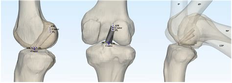Optimal Tunnel Positioning and Graft Diameter to Minimize Impingement ...
