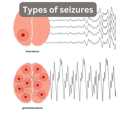 Stroke and Seizure: What to Expect? From Diagnosis to Treatment ...