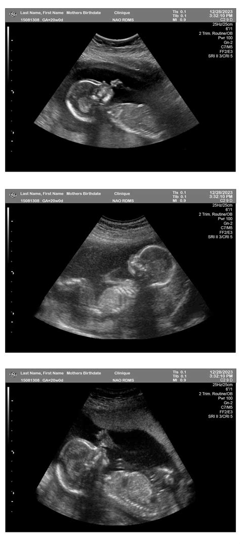 20 Week Pregnancy Ultrasound - Ultrasounds