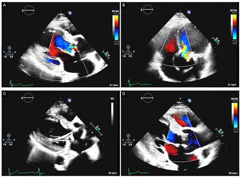 Bioprosthetic Aortic Valve Degeneration After TAVR and SAVR: Incidence ...