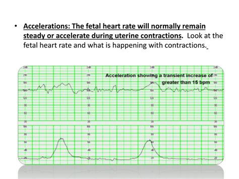 PPT - Fetal Heart Monitoring and Doppler Velocimetry PowerPoint ...