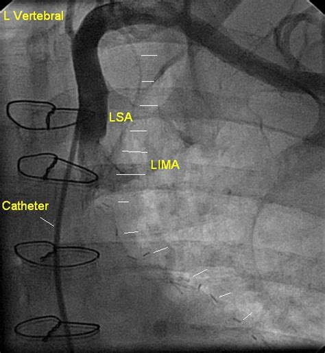 Internal Mammary Artery