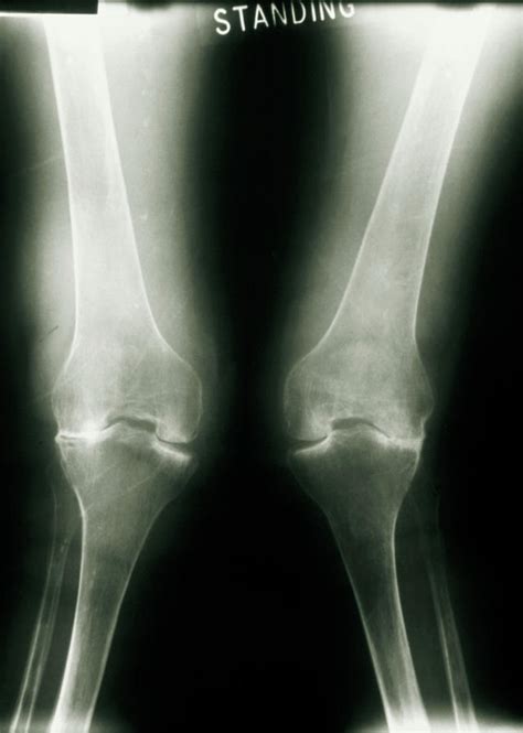 X-ray Of Knee Joints With Rheumatoid Arthritis Photograph by Medical ...