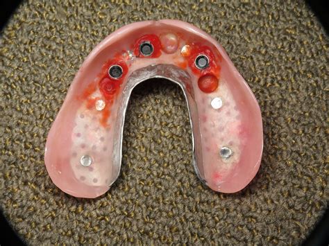 Dental Implant "Overdenture" Basics - Dr. Ramsey Amin, Burbank, CA