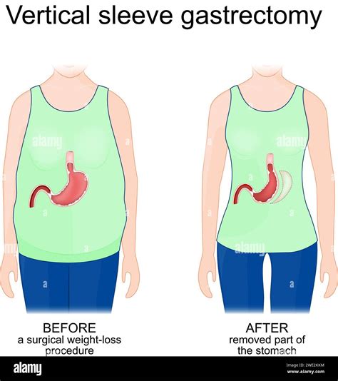 Vertical sleeve gastrectomy. Human body before a surgical weight-loss procedure and after ...