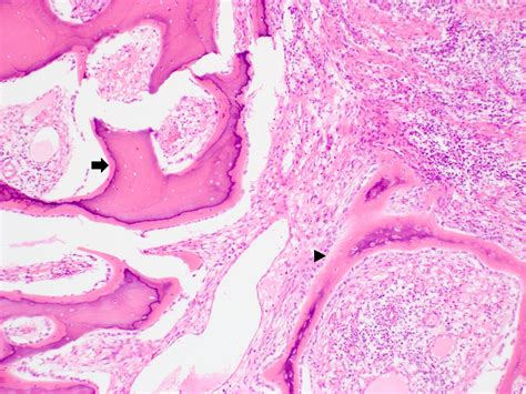 Ossifying Fibroma Histology