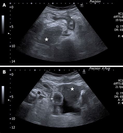 What Does Appendicitis Look Like On Ultrasound at Aurelia Dion blog