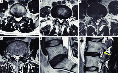 Image result for Foraminal Disc Extrusion
