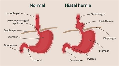 Hiatal hernia (diaphragmatic hernia) in adults and children - Guys and ...