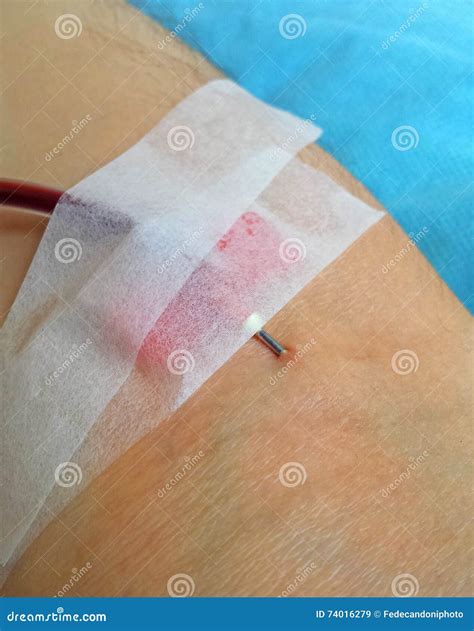 Needle Stuck in the Arm when Donating Blood Stock Image - Image of ...