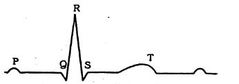The below figure is the diagrammatic representation of standard ECG ...