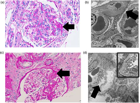 Focal Segmental Glomerulosclerosis