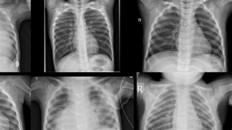 Image result for Medical Image Segmentation MATLAB