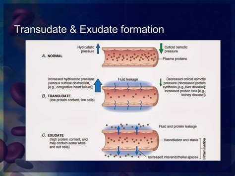 Exudate Vs Transudate