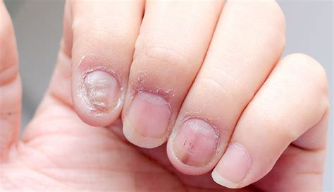 10 Medicinal Uses of Neem Oil To Treat Several Disorders - lifeberrys.com