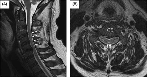 A case of subacute combined degeneration of the spinal cord diagnosed ...