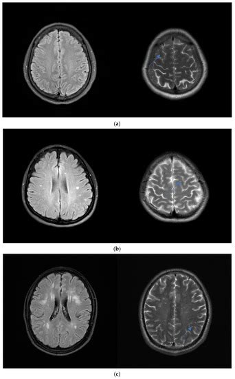 White Matter Hyperintensities in Young Patients from a Neurological ...