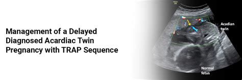 Management of a Delayed Diagnosed Acardiac Twin Pregnancy with TRAP ...