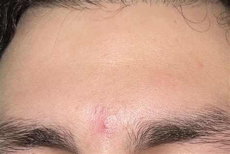 Image result for Blood Red Pimple