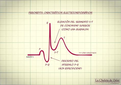 Tercer criterio diagnóstico: ECG con cambios típicos de pericarditis ...