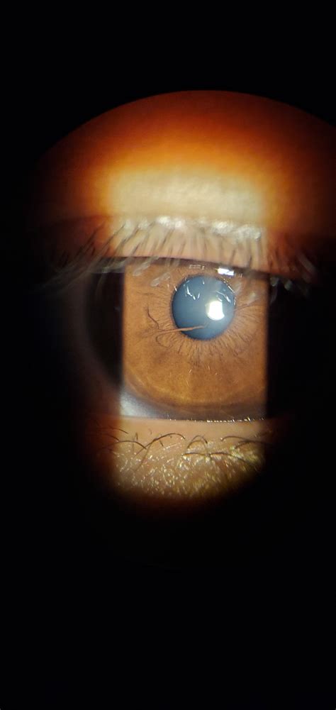 Persistent Pupillary Membrane