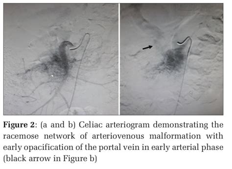 Pancreatic Arteriovenous Malformation: A Case Report and Review of ...