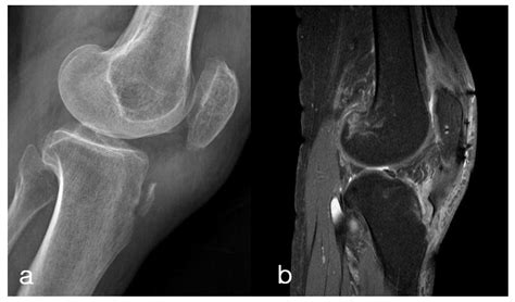 Tibial Tuberosity