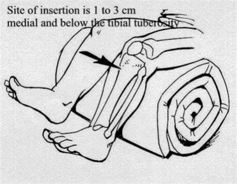 Image result for Intraosseous Access Procedure