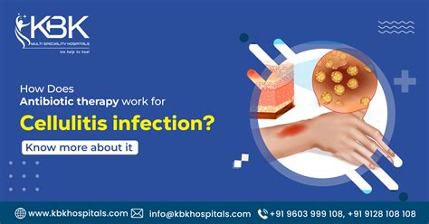 What Cures Cellulitis