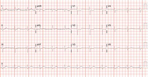 Posterior Myocardial Infarction | ECG Stampede