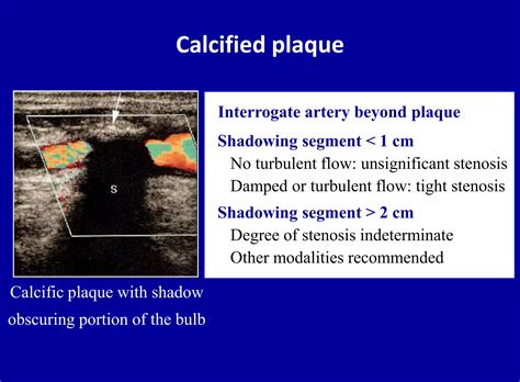 Doppler ultrasound of carotid arteries | PPTX