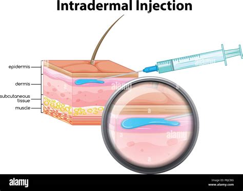 Intradermal Injection on White Background illustration Stock Vector Image & Art - Alamy