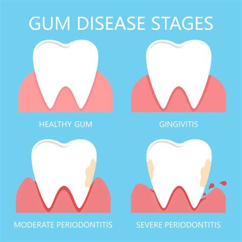 Gum Infection Treatment: A Guide by Dr Marlene Teo on How to Treat Gum Disease