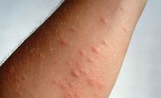 pulci materasso orticaria fisica colpisce gli adolescenti pulci materasso orticaria fisica colpisce gli adolescenti