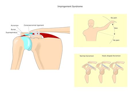 What is SHOULDER IMPINGEMENT SYNDROME? (Signs, Symptoms, & Treatments)