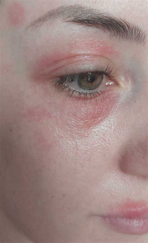 Periocular Dermatitis Around Eyes Psoriasis Around The Eyes: Pictures,