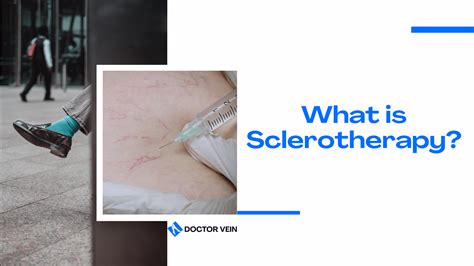 What is Sclerotherapy for varicose veins and spider veins? - Doctor Vein