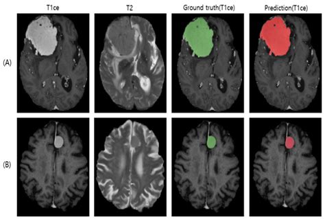 Fully Automated Segmentation Models of Supratentorial Meningiomas Assisted by Inclusion of ...