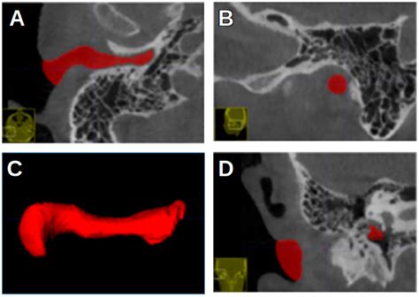 The Reproducibility of Reference Landmarks in the External Acoustic ...